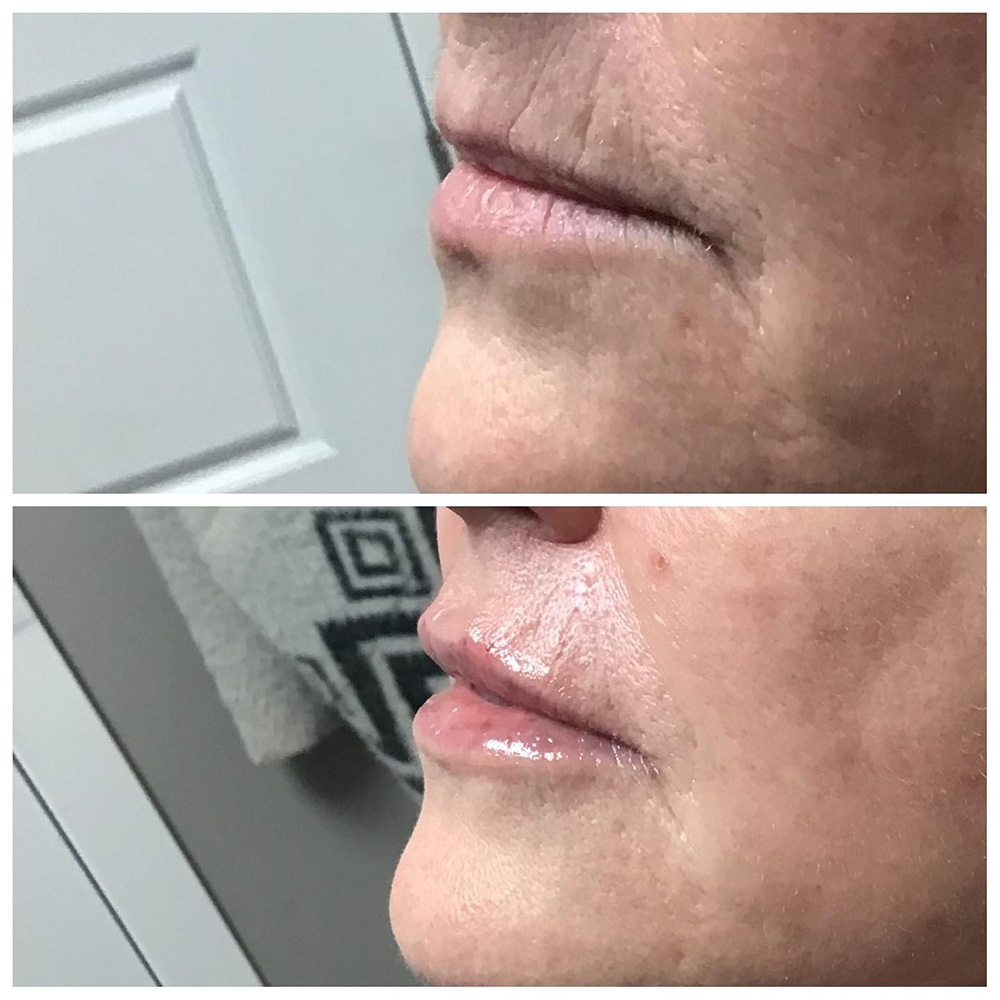 filler for vertical lip lines before and after