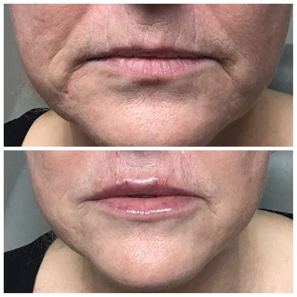 filler for vertical lip lines before and after