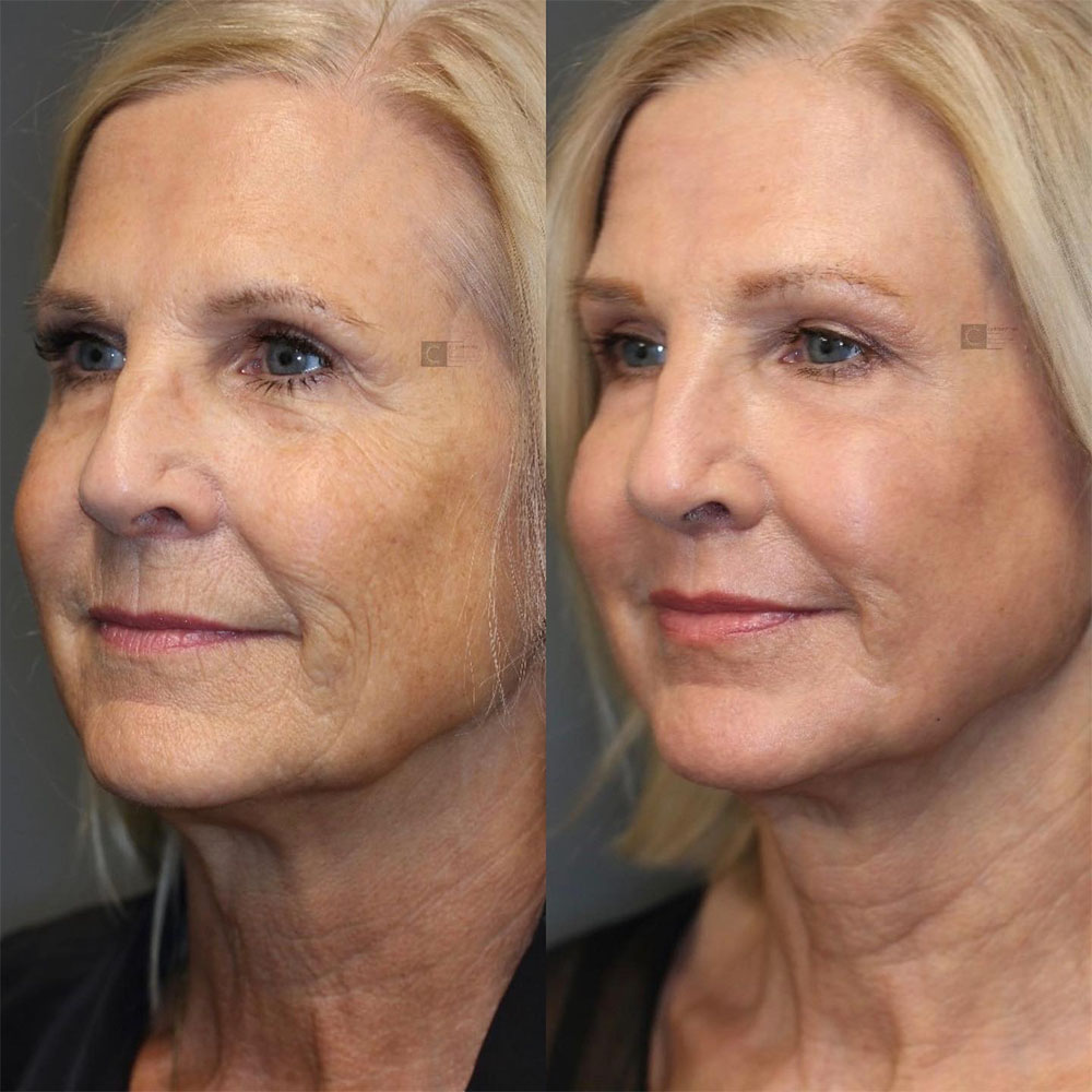 filler for vertical lip lines before and after