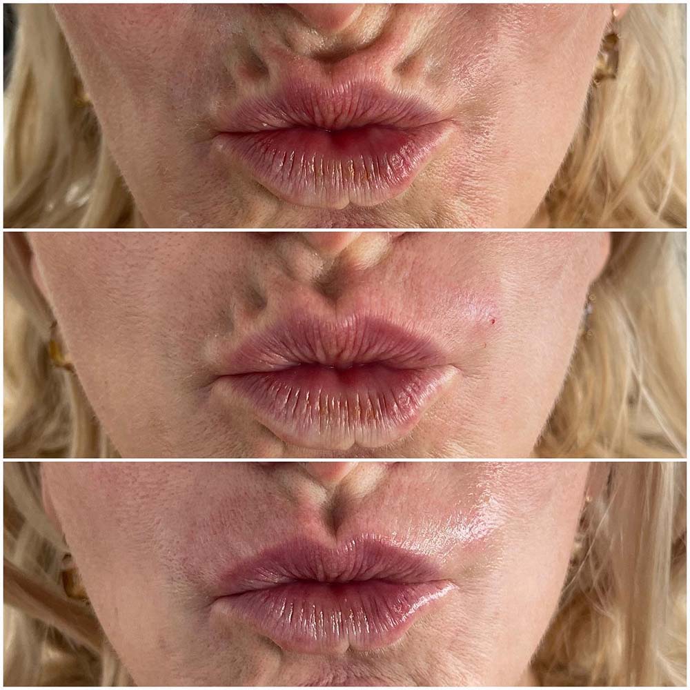 filler for vertical lip lines before and after