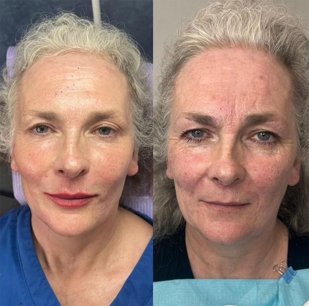 liquid face lift before and after