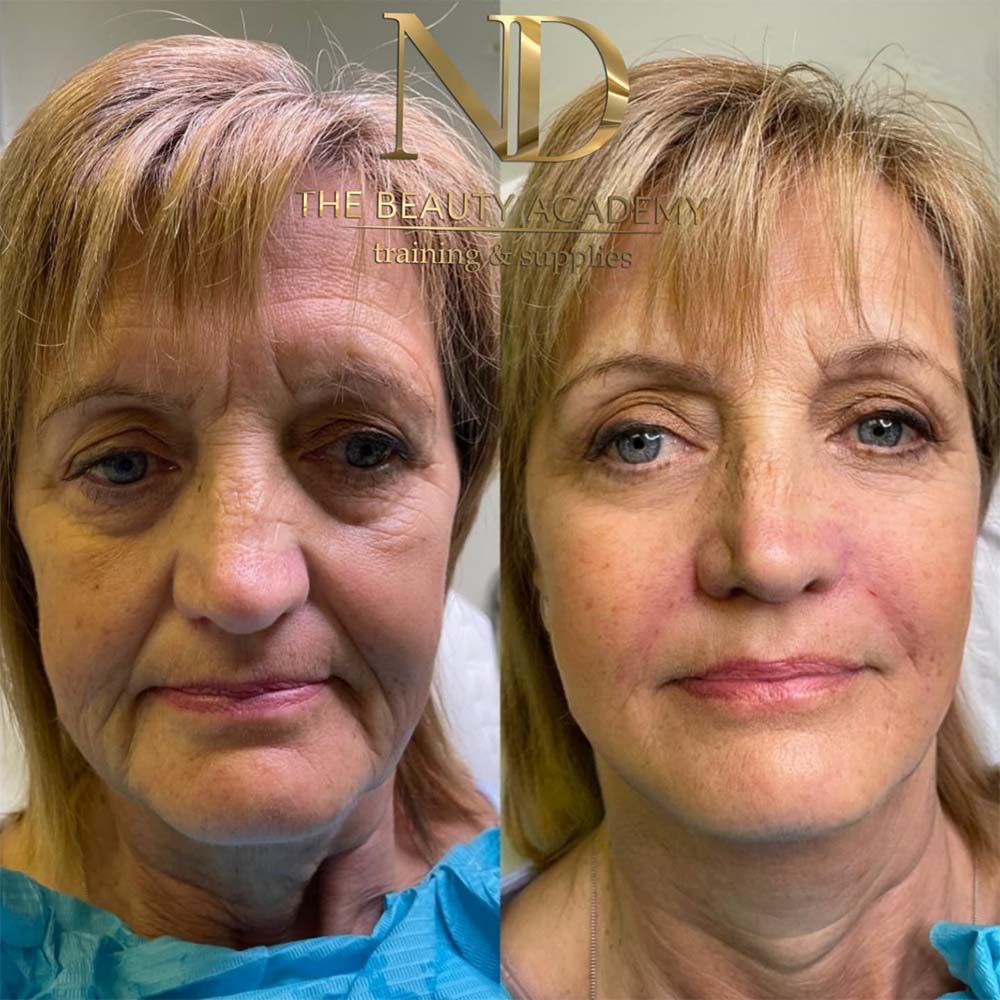 liquid face lift before and after