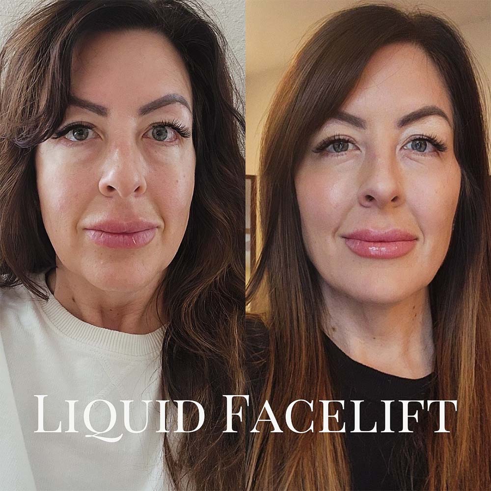 liquid face lift before and after