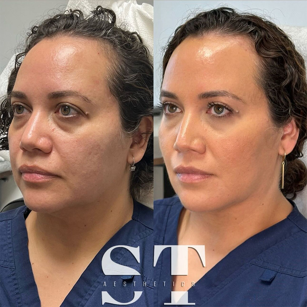 liquid face lift before and after