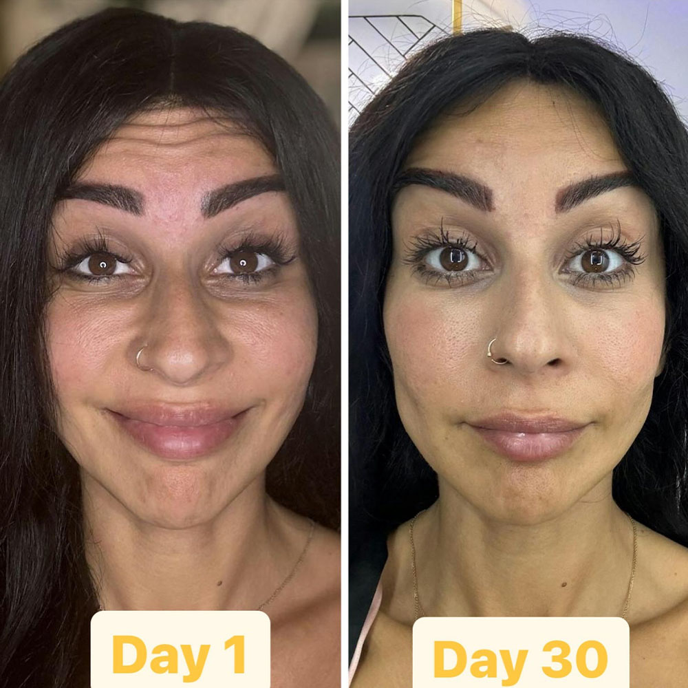 liquid face lift before and after