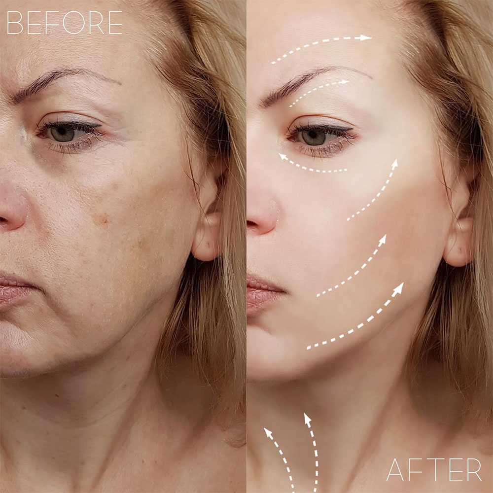 liquid face lift before and after