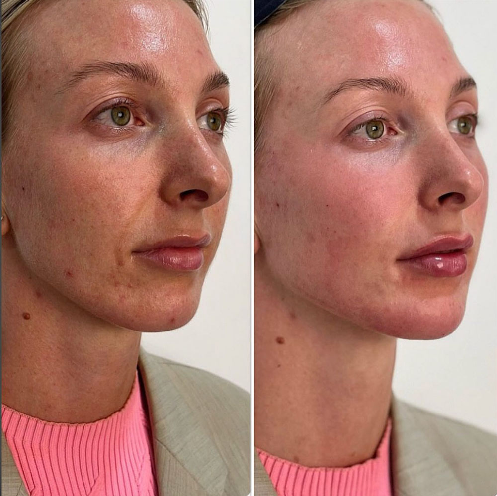 liquid face lift before and after