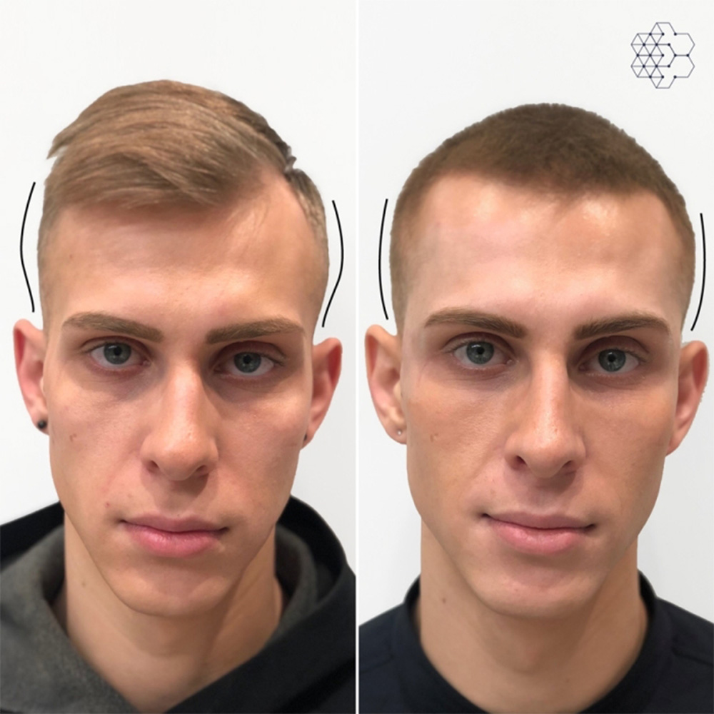 filler in temples to lift eyes