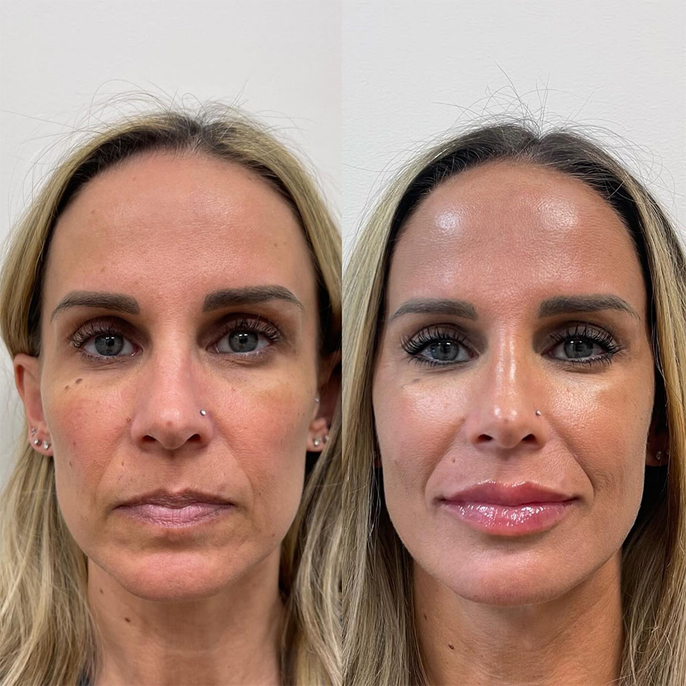 filler in temples to lift eyes