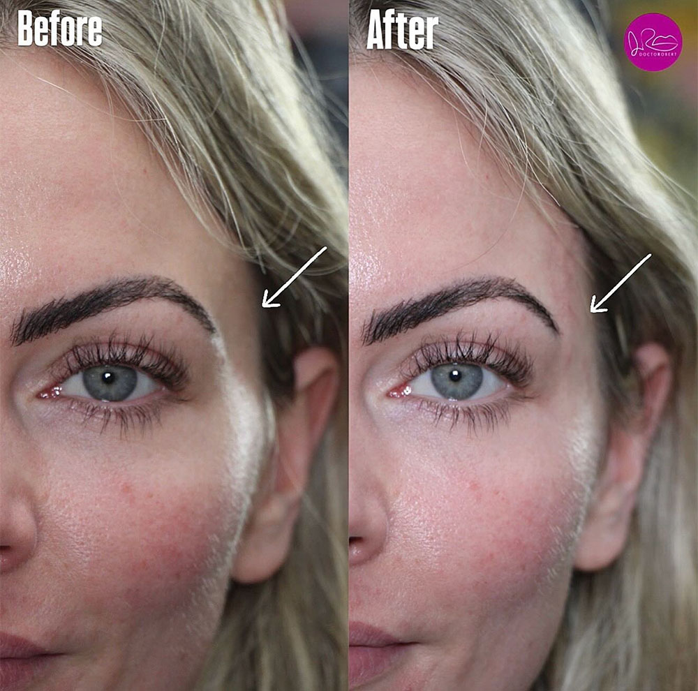 filler in temples to lift eyes