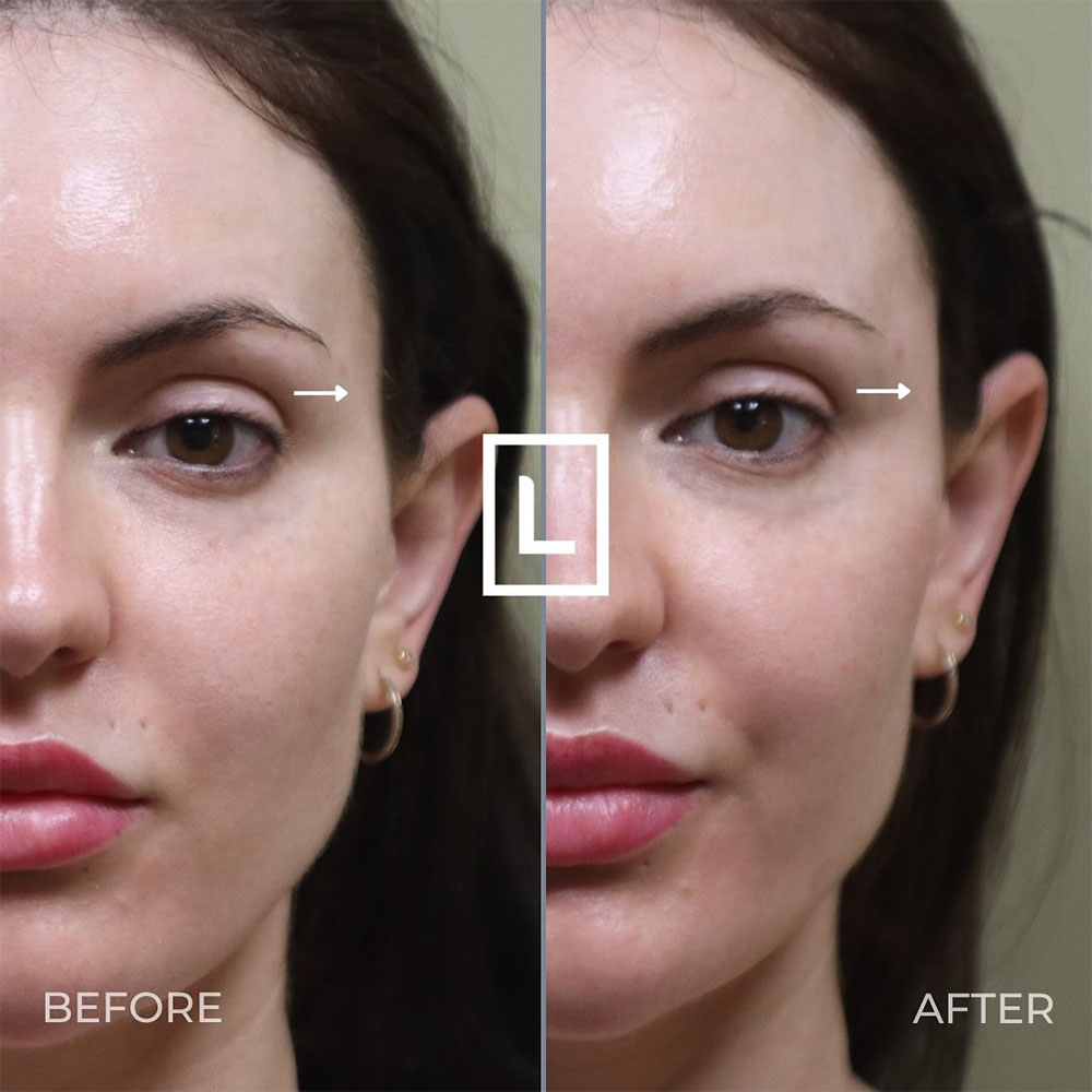 filler in temples to lift eyes
