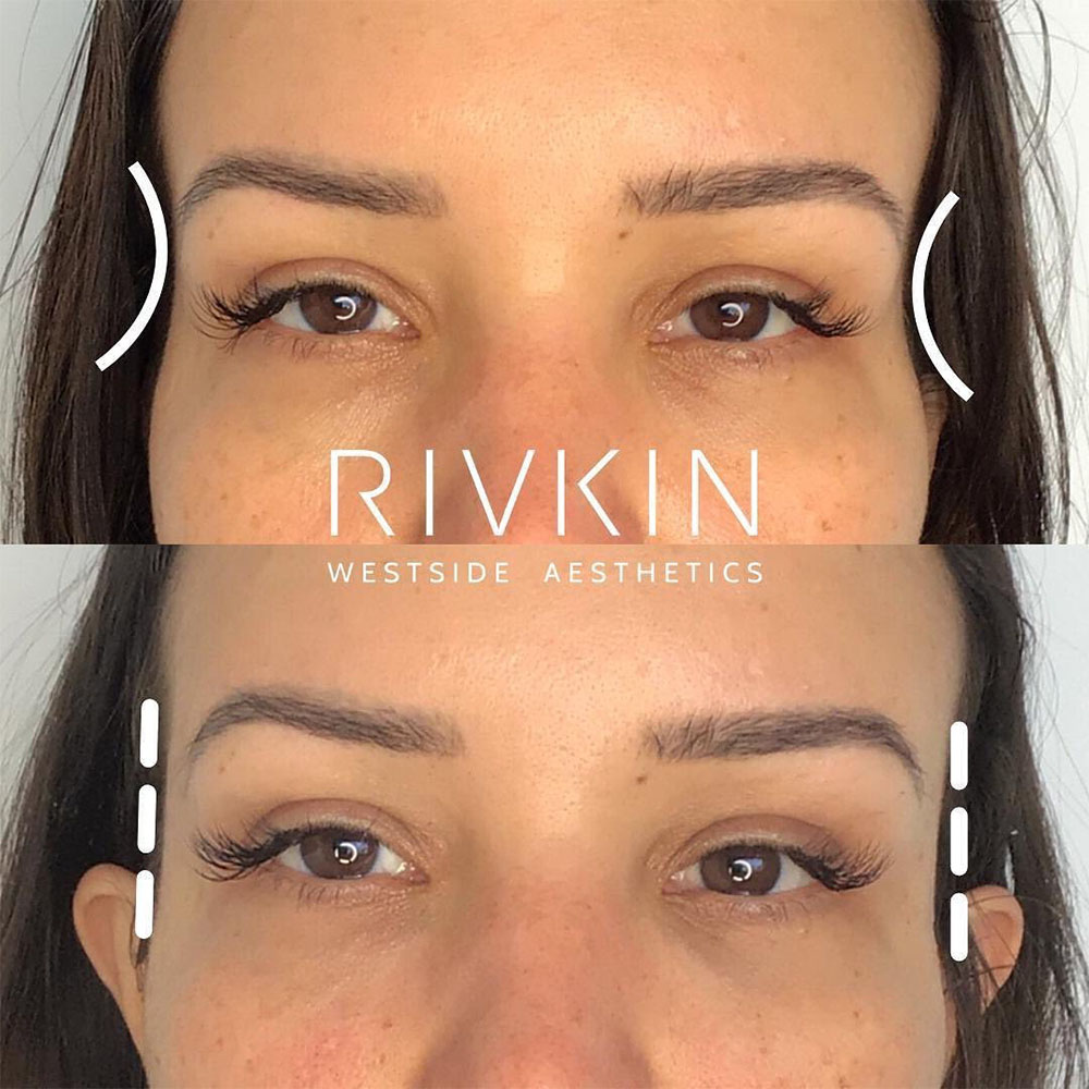 filler in temples to lift eyes