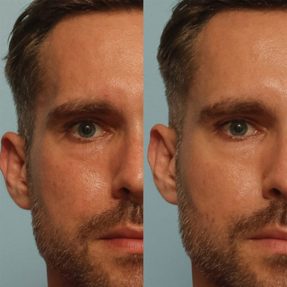 filler in temples to lift eyes