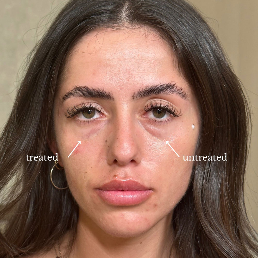 under-eye filler before and after