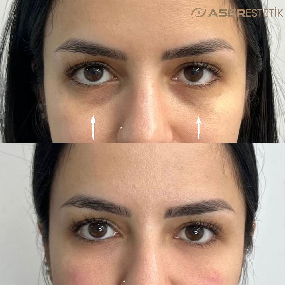 under-eye filler before and after