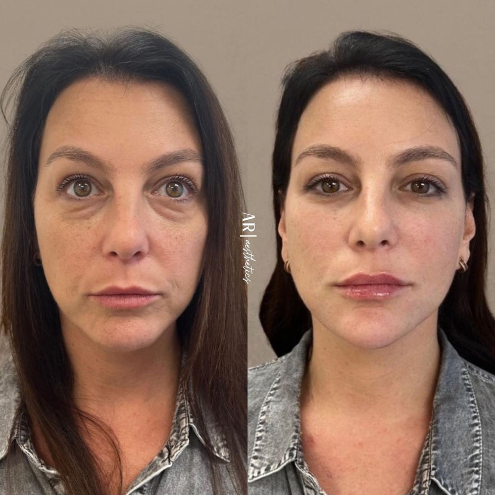 under-eye filler before and after