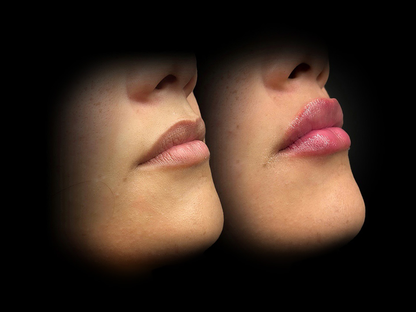 How to Achieve Natural-Looking Lips with Natural Lip Fillers
