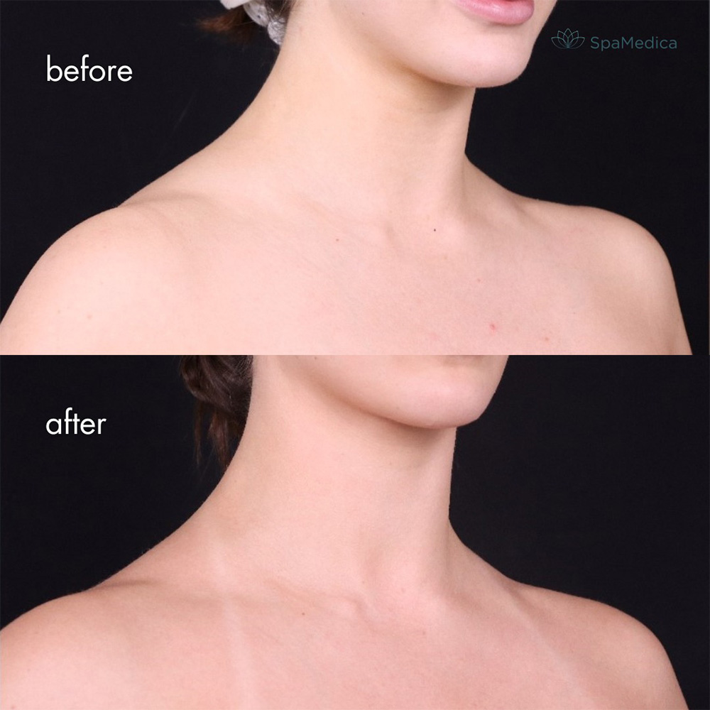 Barbie botox