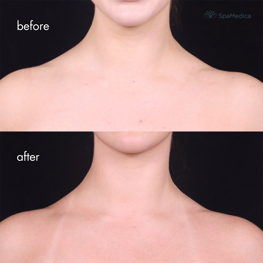 Barbie botox