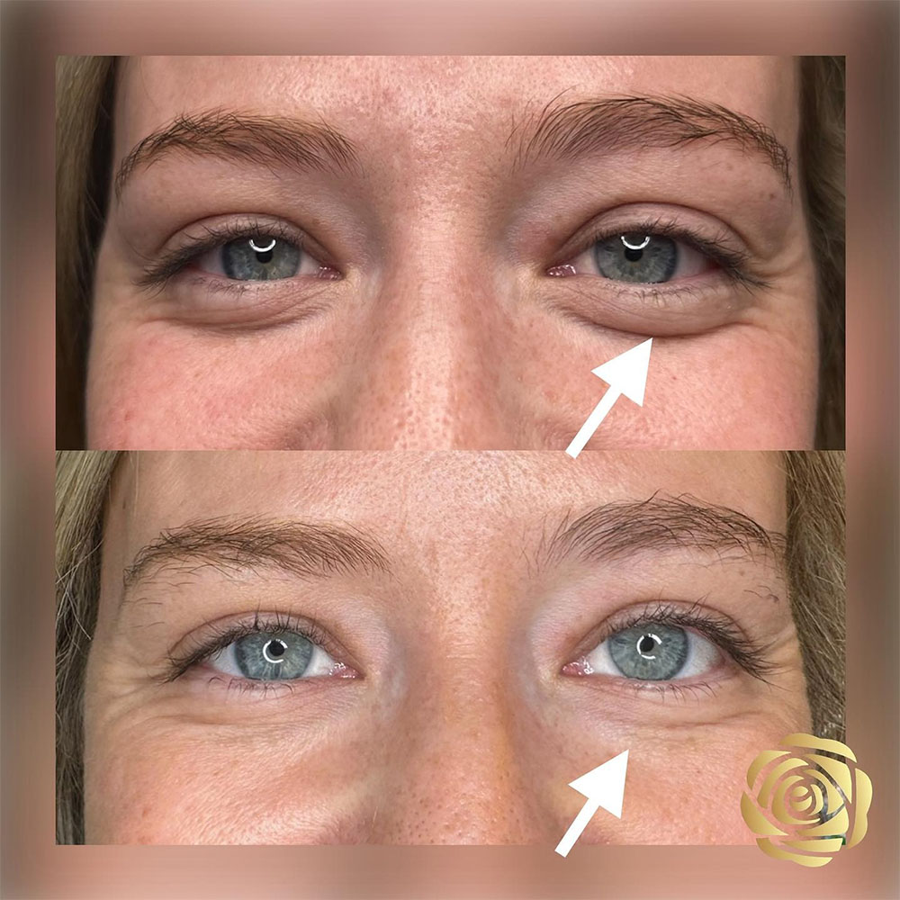 jelly roll botox