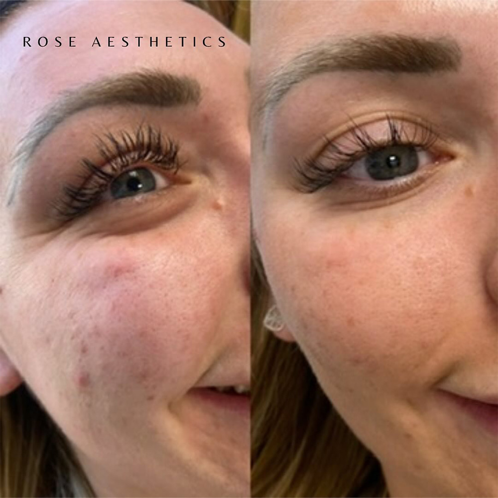 jelly roll botox