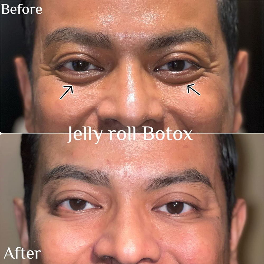 jelly roll botox