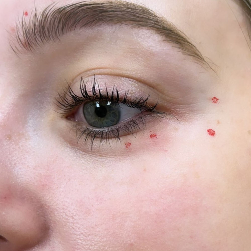 jelly roll botox