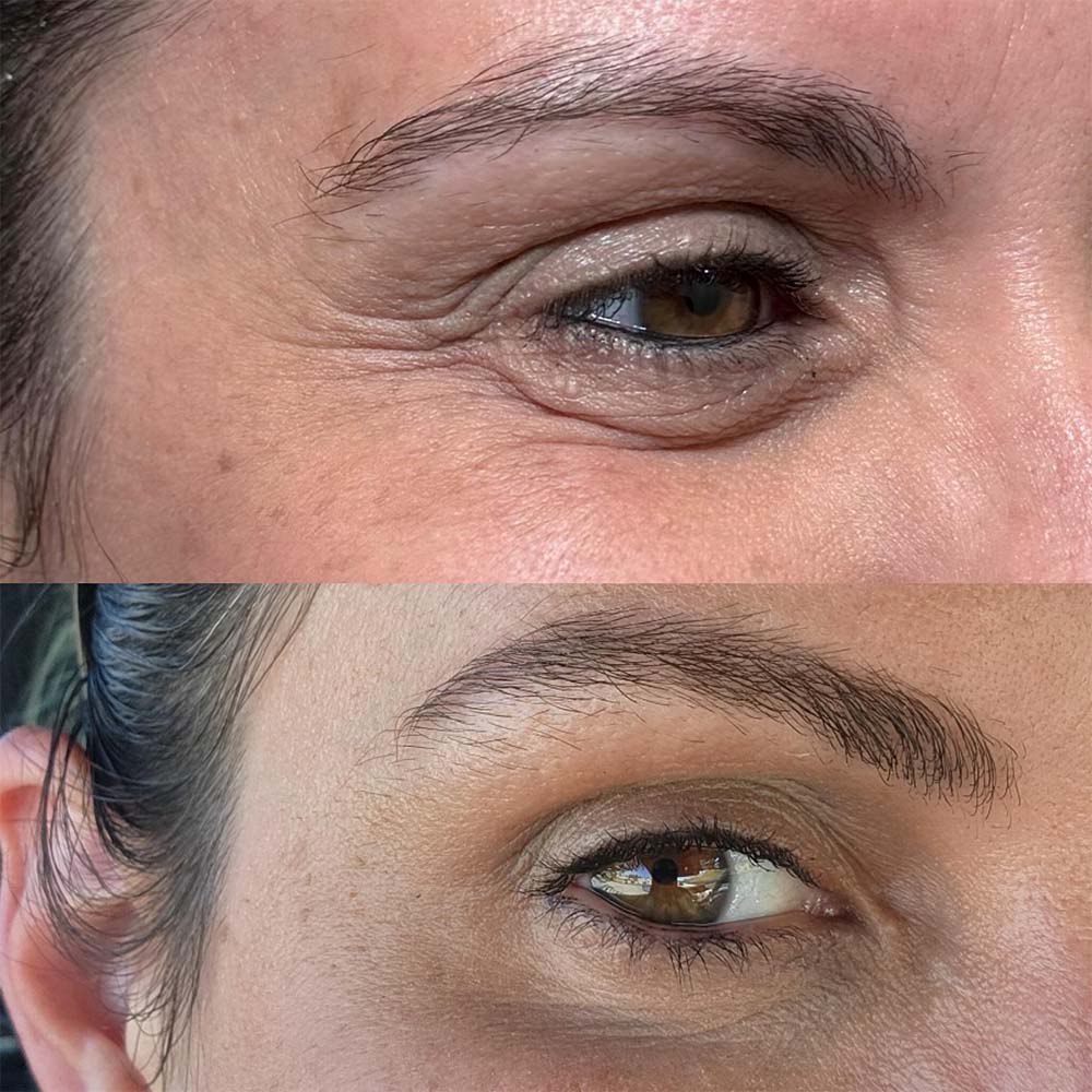 jelly roll botox
