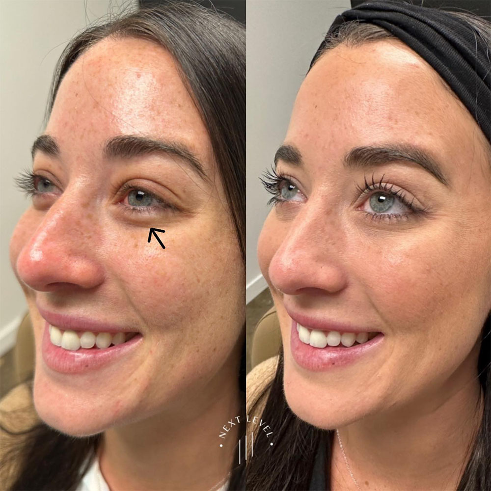 jelly roll botox