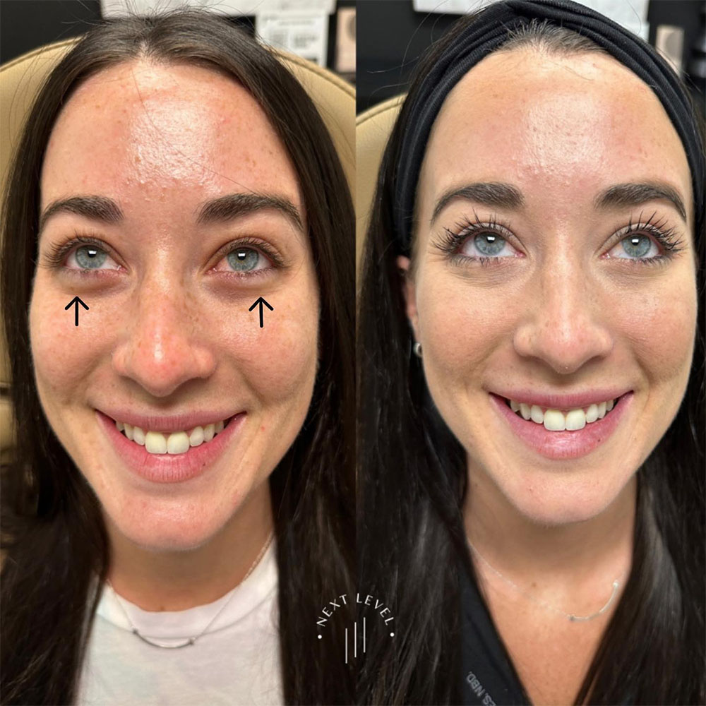 jelly roll botox