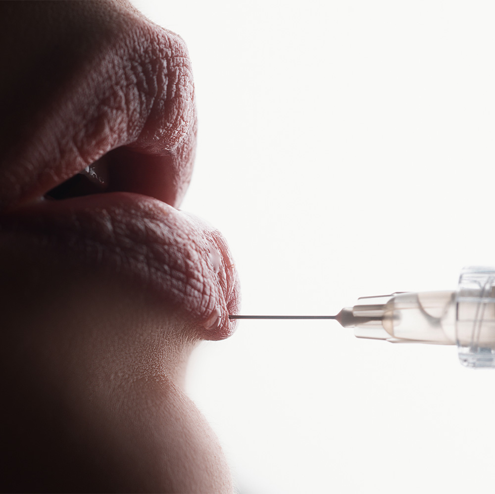 what not to do after lip filler