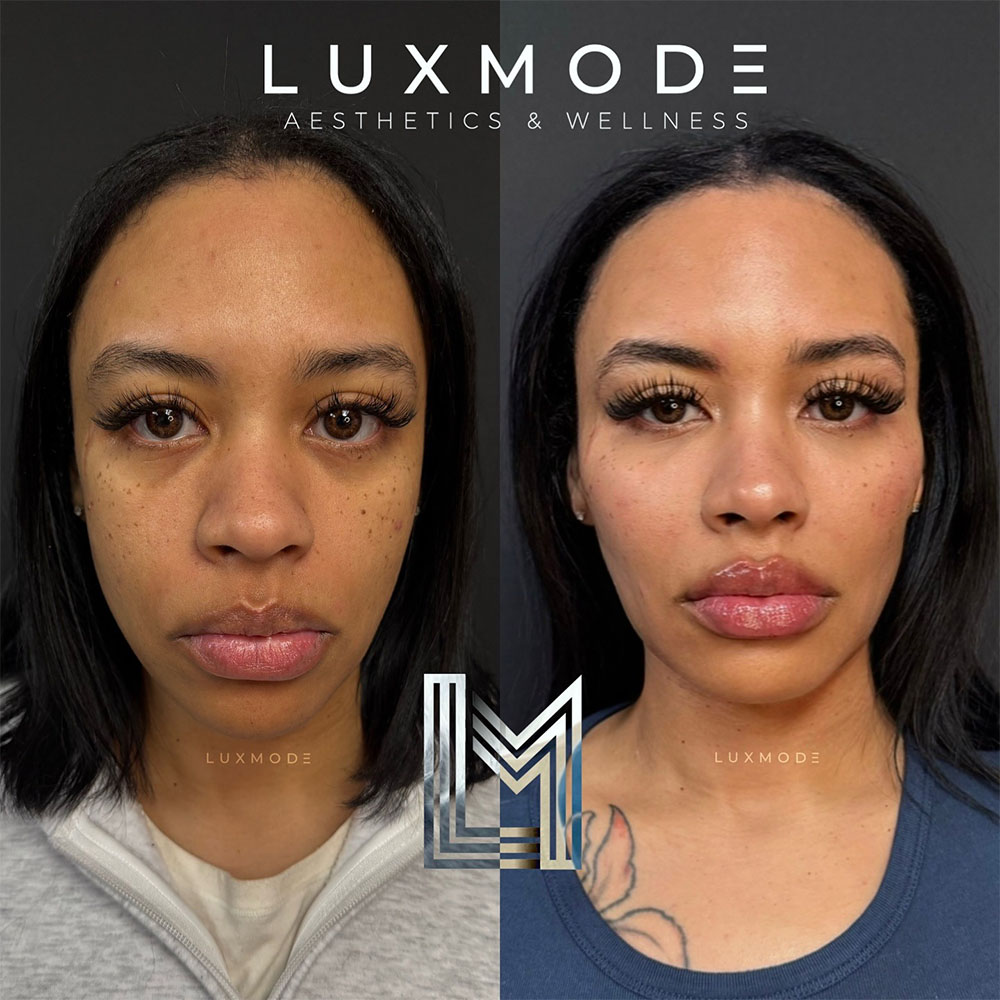 facial balancing example