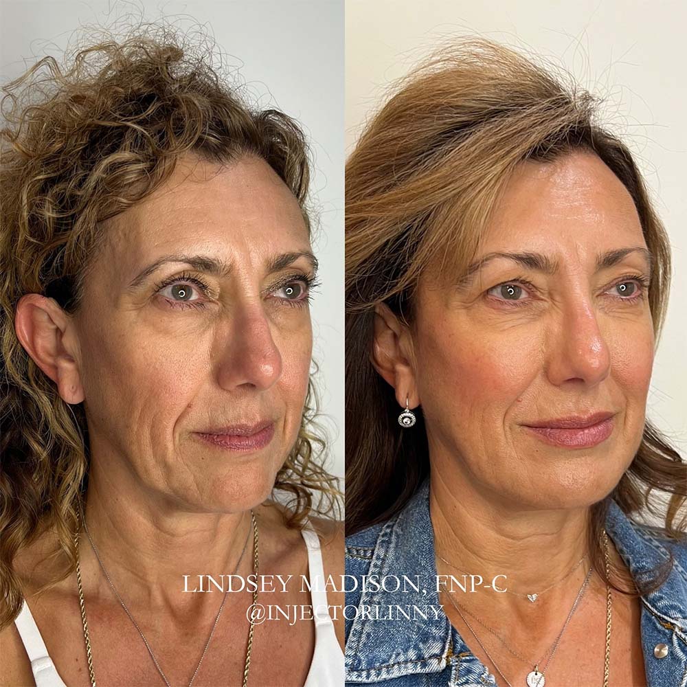 facial balancing before and after