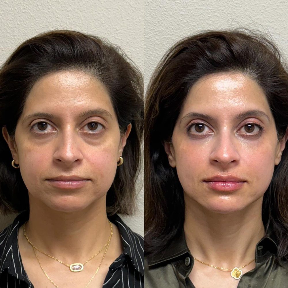 facial balancing with fillers