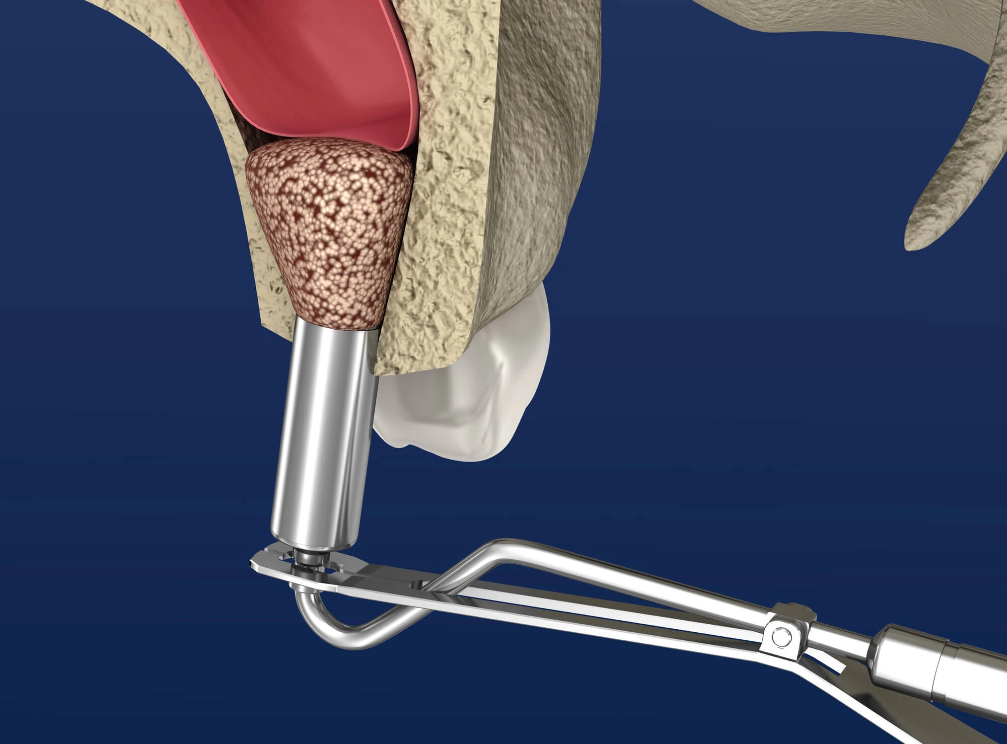 Illustration of a Sinus Lift