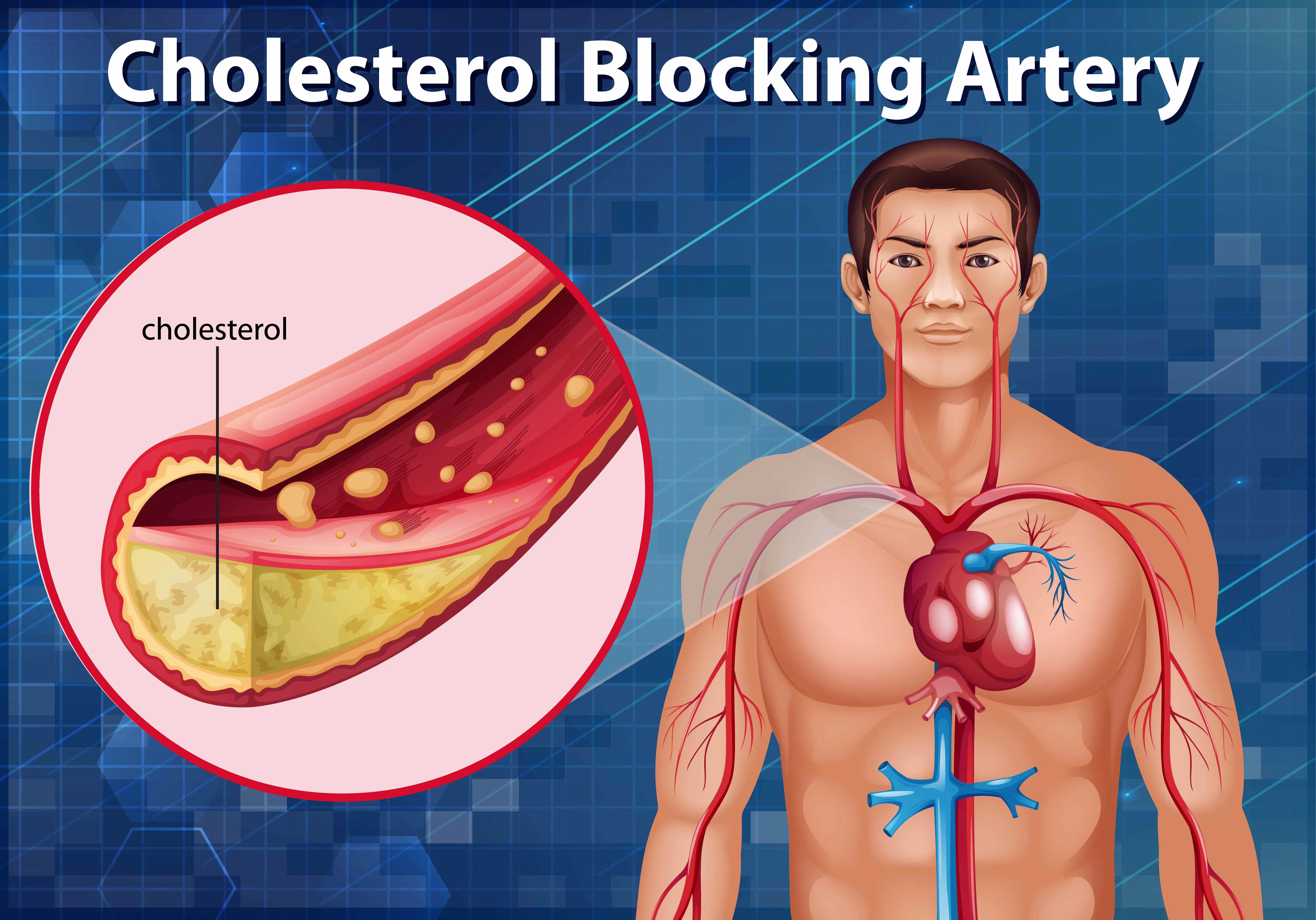 Diagram showing cholesterol blocking artery in human body