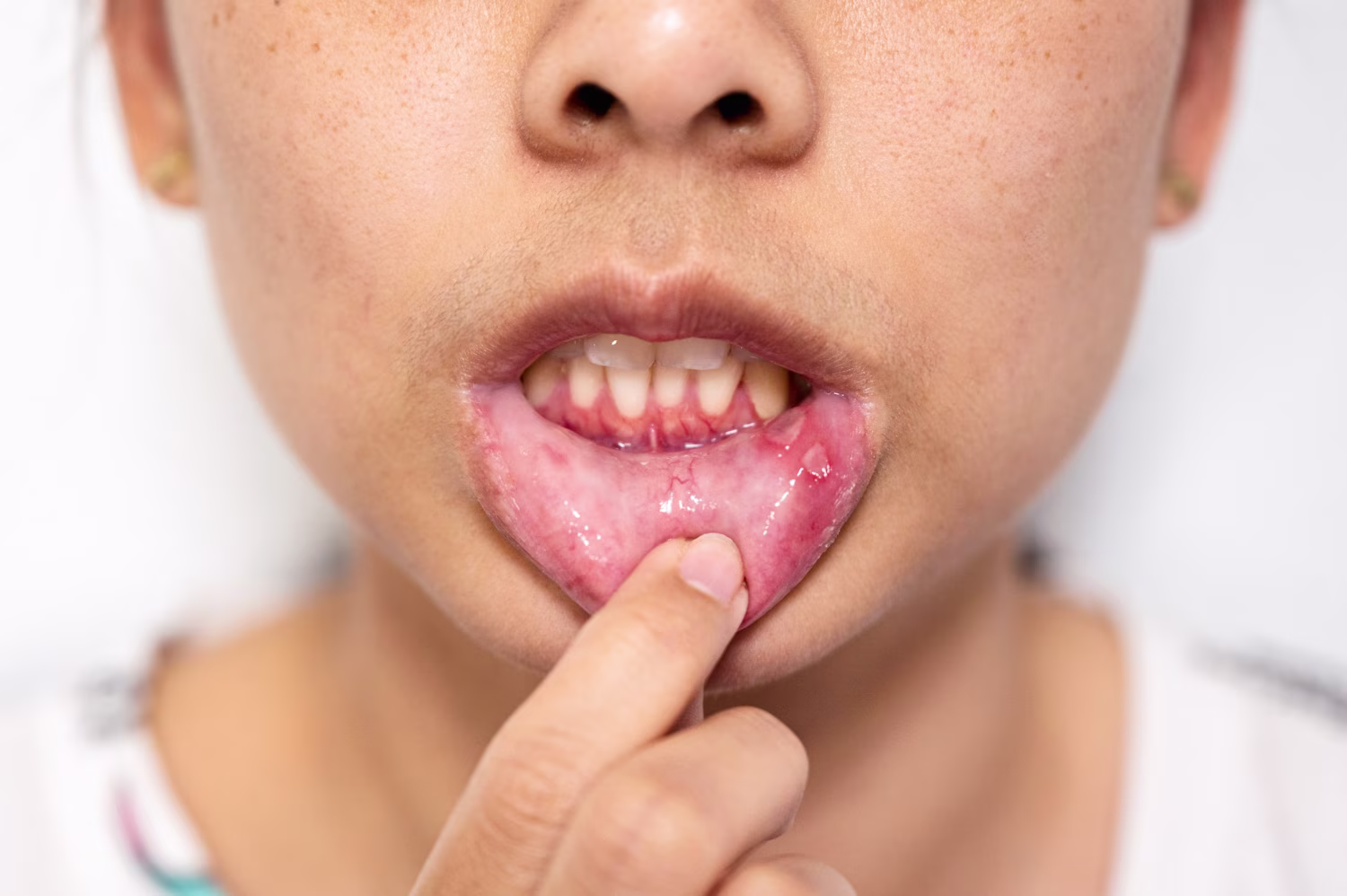 Close-up woman have oral allergy