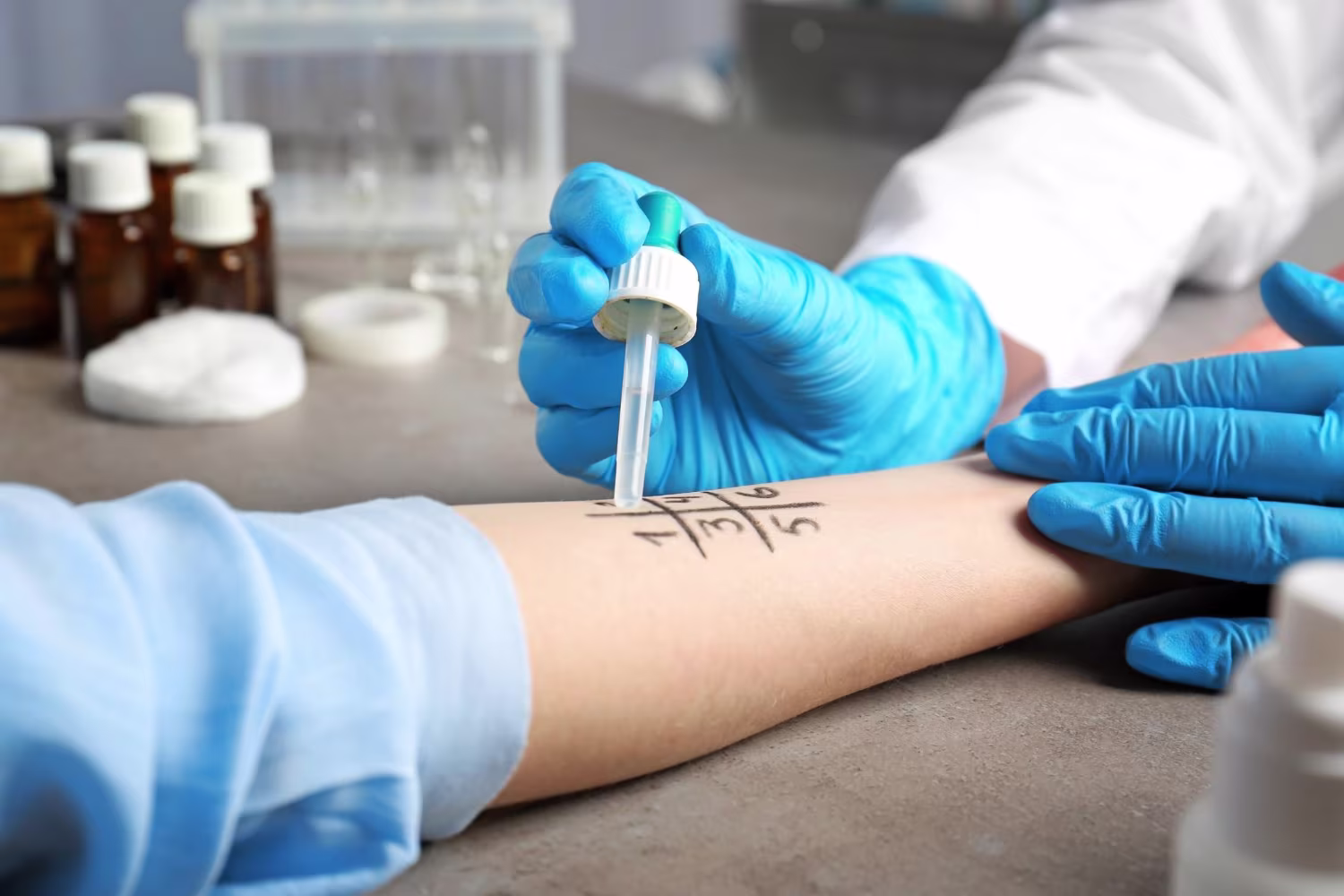 Doctor making allergy test in laboratory