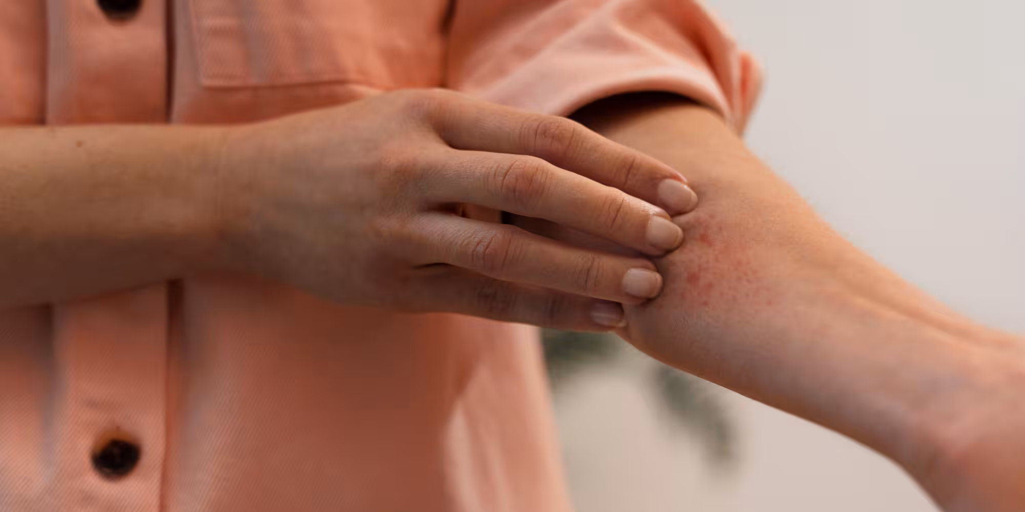 Flea Bites: What They Look Like, Symptoms & Treatment