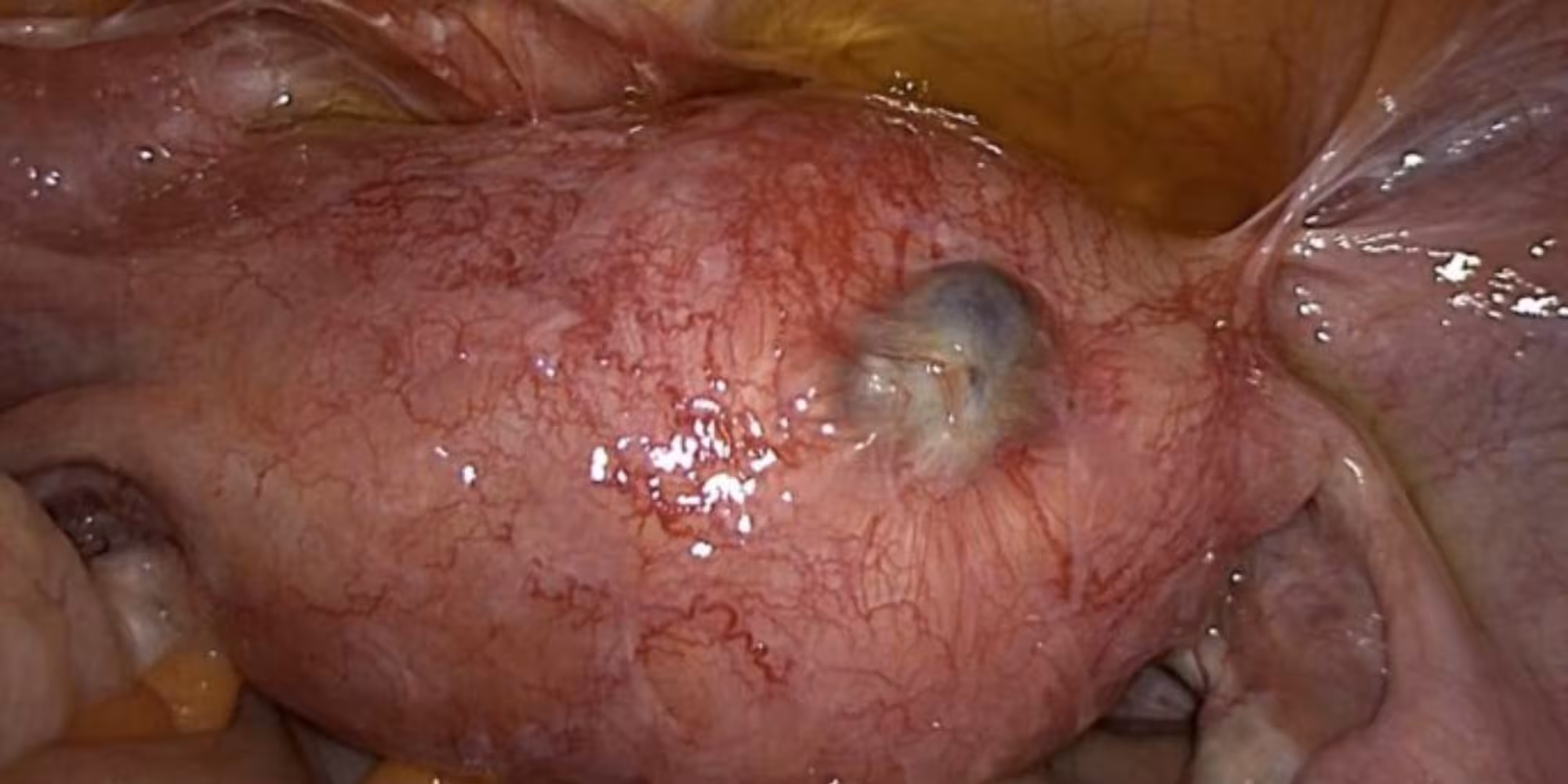 Adenomyosis: Symptoms, Causes & Treatment