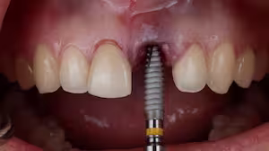 Mastering Implants in the Esthetic Zone