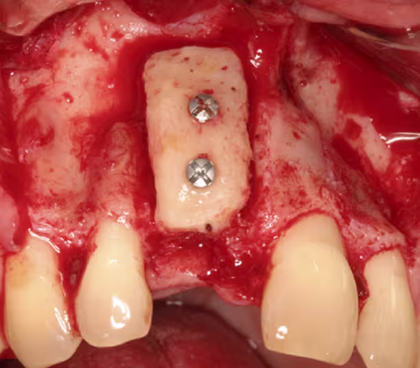 Alveolar Ridge Strategies