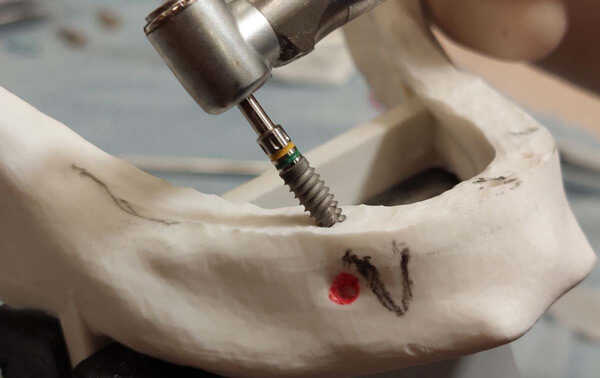 Full Arch Implant Boot Camp Level 1