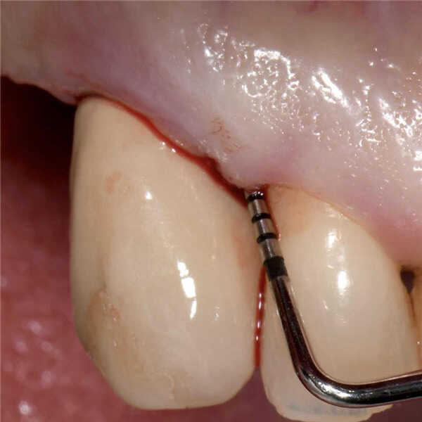 Mastering Peri-Implantitis Treatment