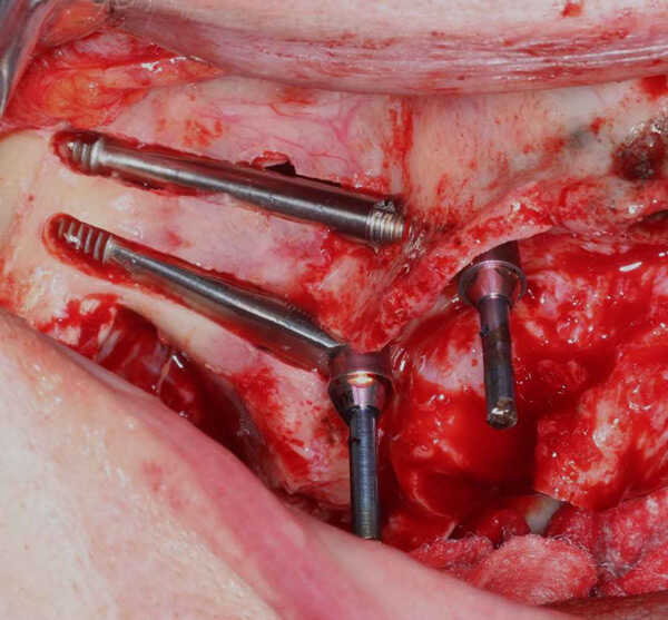 Full Spectrum Zygomatic and Pterygoid Implant Therapy Demystified
