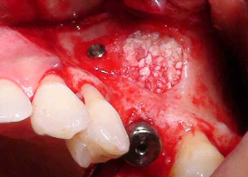 Sinus Grafting for Implant Reconstruction