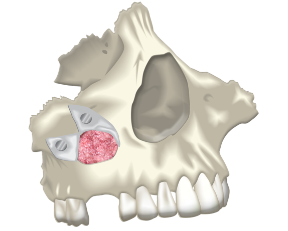 Sinus Grafting for Implant Reconstruction