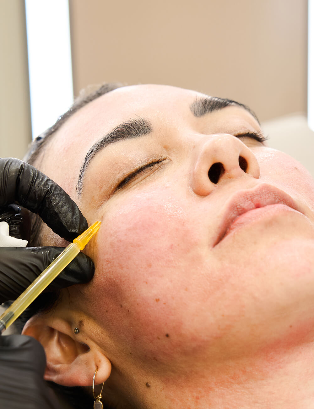 A patient getting a PRP treatment at GenClique Aesthetics 