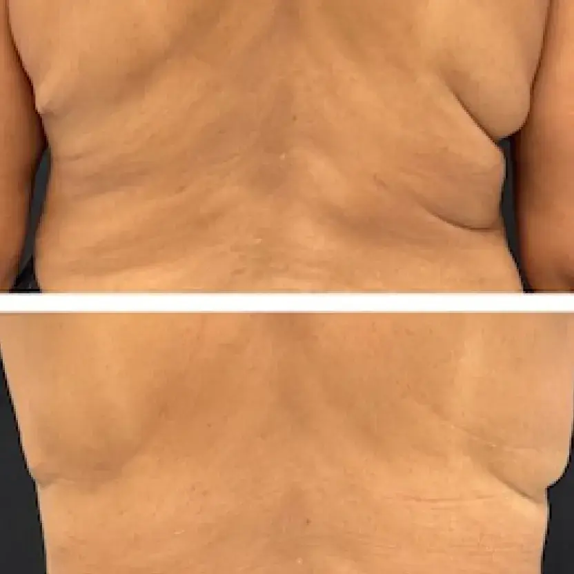 a before and after picture of a woman's breast