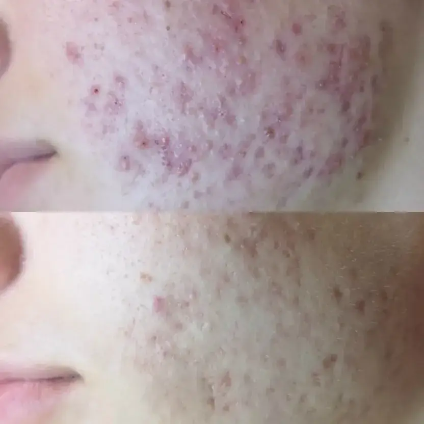a close up of a woman's face with acne